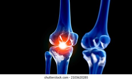 3d Rendered Illustration Of A Painful Knee Joint