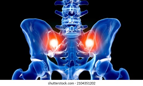 3d Rendered Illustration Of A Painful Sacroiliac Joint