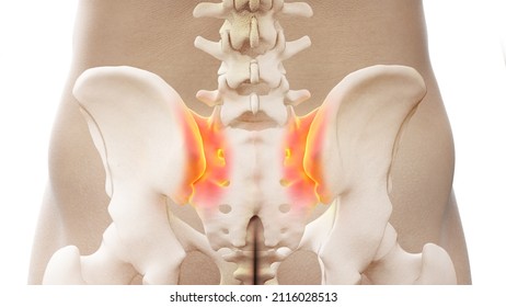 3d Rendered Illustration Of A Painful Sacroiliac Joint