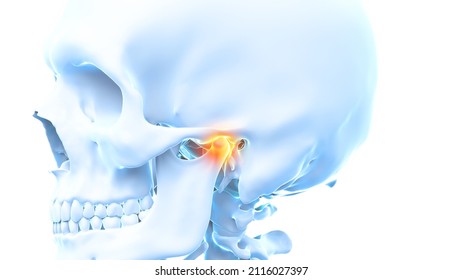 3d Rendered Illustration Of A Painful Temporomandibular Joint