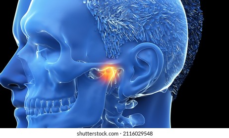 3d Rendered Illustration Of A Painful Temporomandibular Joint