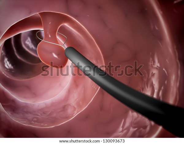 3d Rendered Illustration Polyp Removal Stock Illustration 130093673