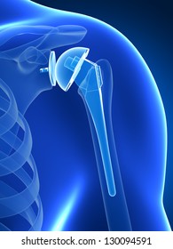 375 Shoulder replacement Images, Stock Photos & Vectors | Shutterstock