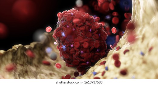 3d Rendered Illustration Of A Thrombus