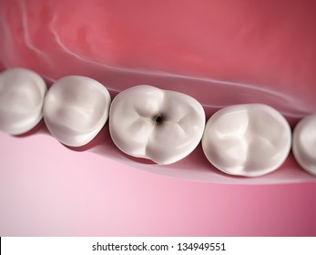 3d Rendered Illustration Of Tooth Decay