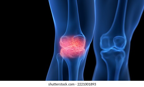 3d Rendered Medical Illustration Of An Arthritic Knee Joint