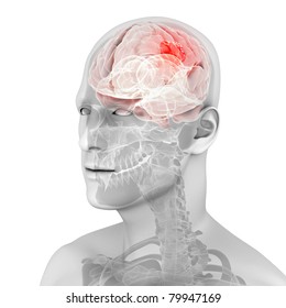 3d Rendered Medical Illustration Of A Brain Tumor