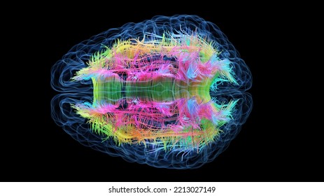 3d Rendered Medical Illustration Of Colored White Brain Matter Fibres