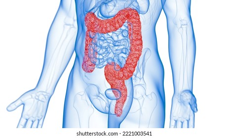 3d Rendered Medical Illustration Of An Inflamed Colon