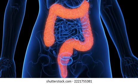 3d Rendered Medical Illustration Of An Inflamed Colon