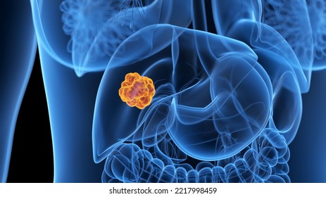 3d Rendered Medical Illustration Of A Liver Tumor