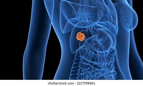 3d Rendered Medical Illustration Of A Liver Tumor