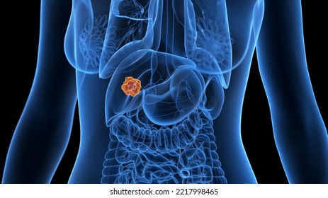 3d Rendered Medical Illustration Of A Liver Tumor