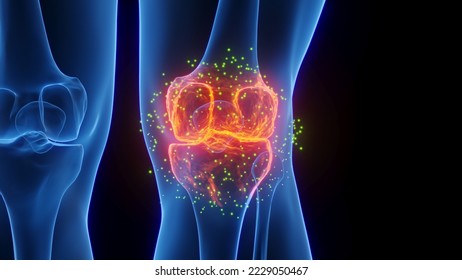 3D rendered Medical Illustration of Male Anatomy - Inflamed Knee undergoing Healing. Plain Black Background. Left side - Powered by Shutterstock