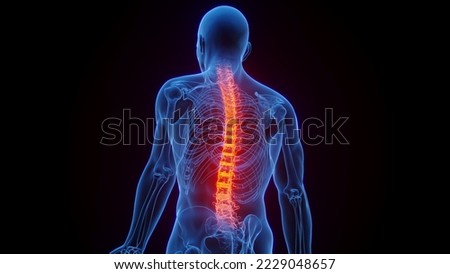 3D rendered Medical Illustration of Male Anatomy - Inflamed Spine. Plain Black Background. Posterior lateral view. Stockfoto © 