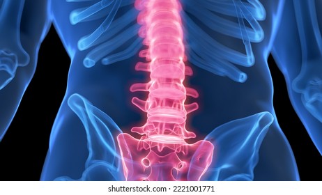 3d Rendered Medical Illustration Of A Painful Lower Spine