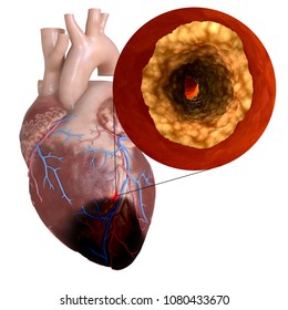 3d rendered, medically accurate illustration of a heart attack