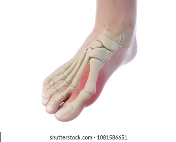 3d rendered, medically accurate illustration of a bunion