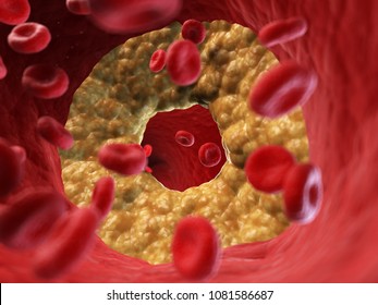 3d Rendered, Medically Accurate Illustration Of A Blocked Artery