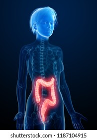 3d Rendered Medically Accurate Illustration Of An Inflamed Colon