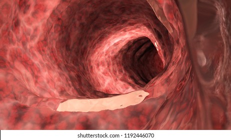 3d Rendered Medically Accurate Illustration Of An Inflamed Colon 