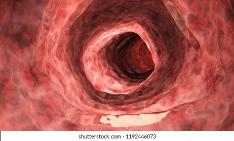 3d Rendered Medically Accurate Illustration Of An Inflamed Colon 