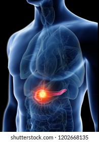 3d Rendered Medically Accurate Illustration Of A Mans Pancreas Tumor