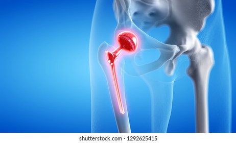 3d rendered medically accurate illustration of a painful hip replacement