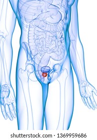 3d Rendered Medically Accurate Illustration Of An Inflamed Prostate