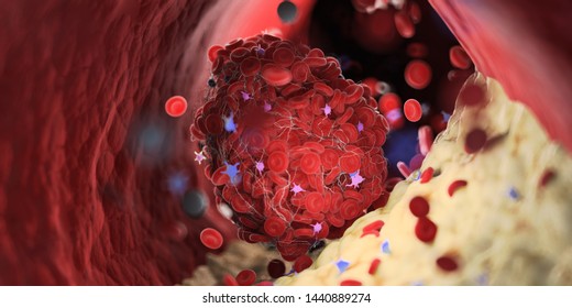 3d rendered medically accurate illustration of a thrombus emerging from a capped plaque