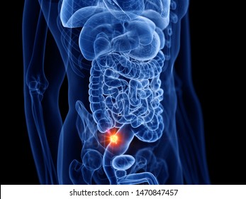 3d Rendered Medically Accurate Illustration Of Appendix Cancer