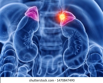 3d rendered medically accurate illustration of adrenal gland cancer