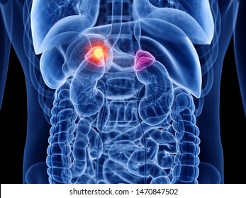 3d rendered medically accurate illustration of adrenal gland cancer