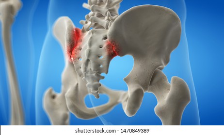 3d rendered medically accurate illustration of an arthritic iliosacral joint