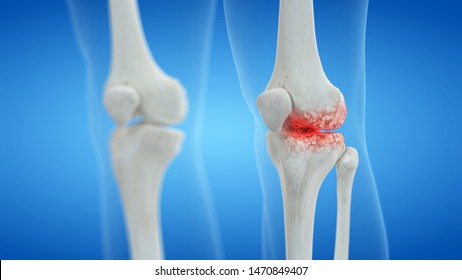 3d Rendered Medically Accurate Illustration Of An Arthritic Knee Joint