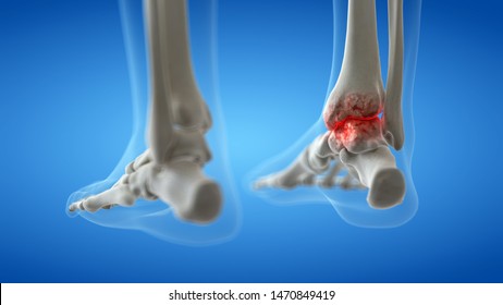 3d Rendered Medically Accurate Illustration Of An Arthritic Ankle Joint