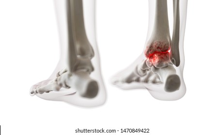 3d Rendered Medically Accurate Illustration Of An Arthritic Ankle Joint