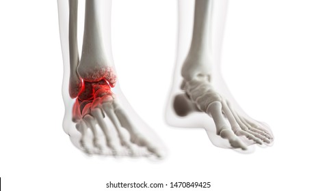 3d Rendered Medically Accurate Illustration Of An Arthritic Ankle Joint