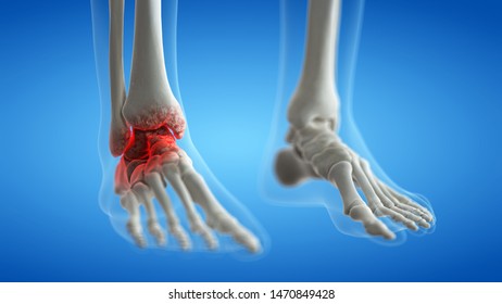 3d Rendered Medically Accurate Illustration Of An Arthritic Ankle Joint