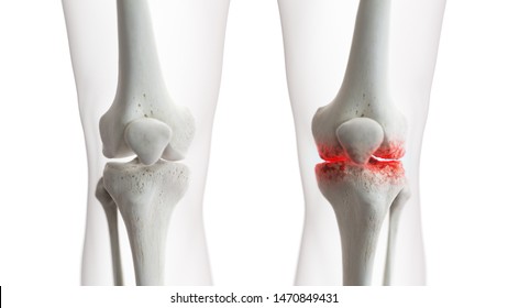 3d Rendered Medically Accurate Illustration Of An Arthritic Knee Joint