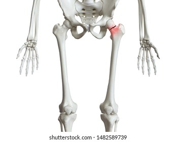 3d Rendered Medically Accurate Illustration Of A Broken Femur Neck