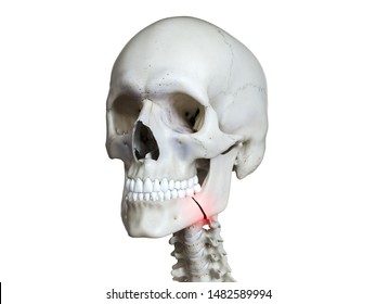 3d Rendered Medically Accurate Illustration Of A Broken Jaw