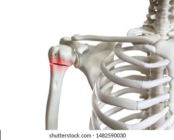 3d rendered medically accurate illustration of a broken humerus