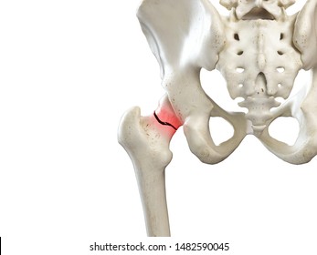 3d Rendered Medically Accurate Illustration Of A Broken Femur Neck