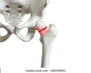 3d Rendered Medically Accurate Illustration Of A Broken Femur Neck