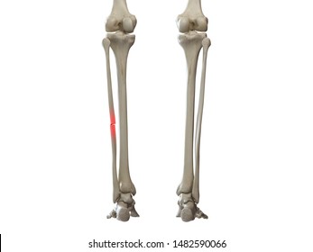 3d Rendered Medically Accurate Illustration Of A Broken Fibula