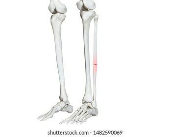 3d Rendered Medically Accurate Illustration Of A Broken Fibula