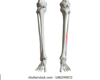 3d Rendered Medically Accurate Illustration Of A Broken Fibula