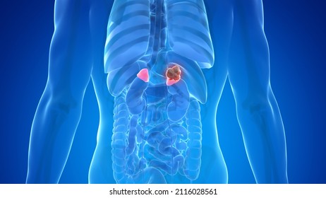 3d Rendered Medically Accurate Illustration Of Adrenal Gland Cancer