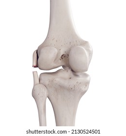 3d rendered medically accurate illustration of a torn fibular collateral ligament